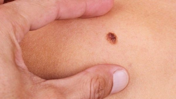 Онколог рассказал о первых признаках рака кожи