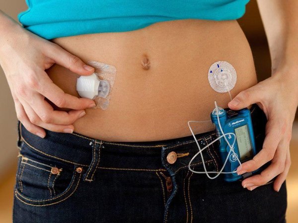 Терапия нового поколения: что такое инсулиновые помпы и в чем их преимущества
