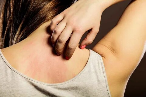 Названы самые частые проявления штамма «омикрон» на коже